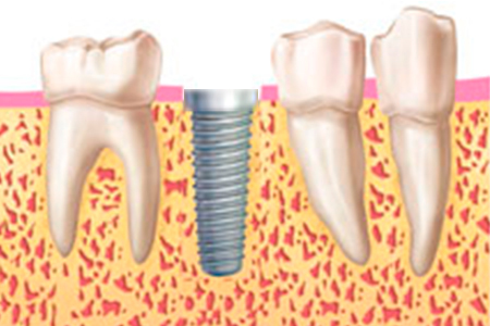 corona implantes Corona implantes