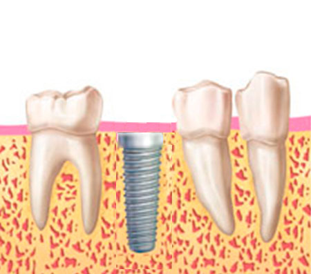 corona implantes corona implantes