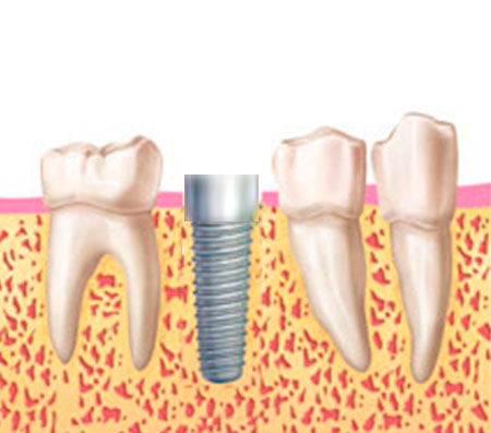 corona implante corona implante