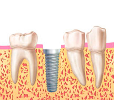 corona implante corona implante