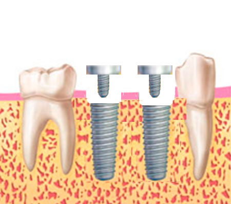 corona implante corona implante