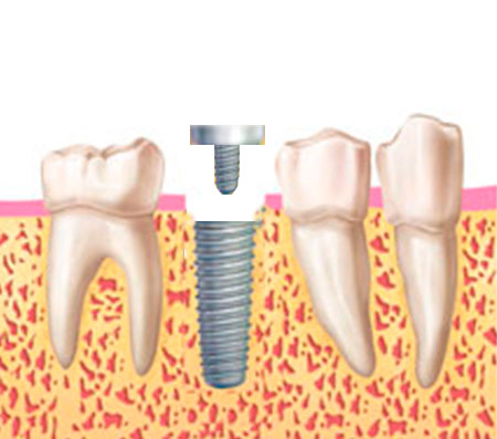 corona implante corona implante
