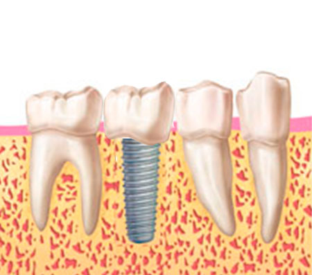 coronas implantes coronas implantes