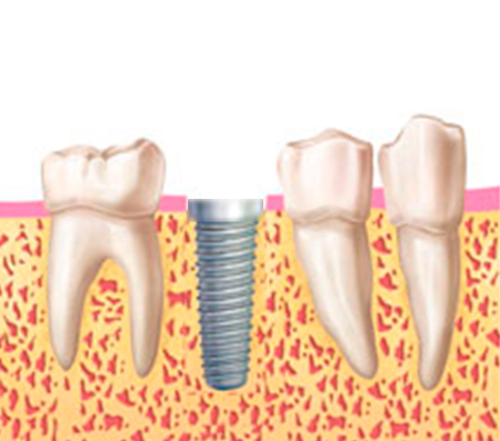 coronas implantes coronas implantes
