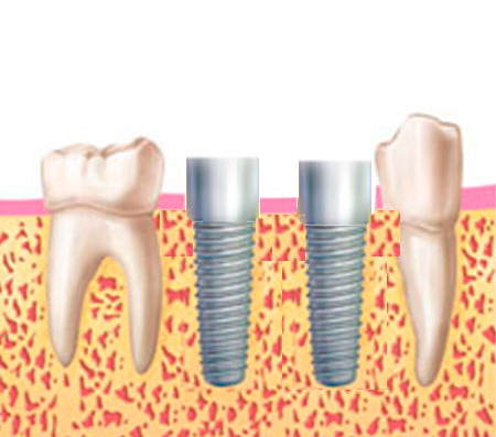 coronas implantes coronas implantes