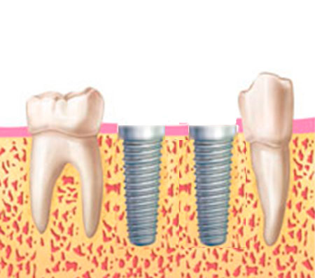 coronas implantes coronas implantes