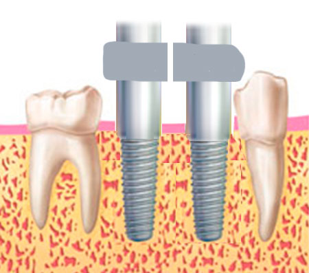 dientes fijos implantes dientes fijos implantes