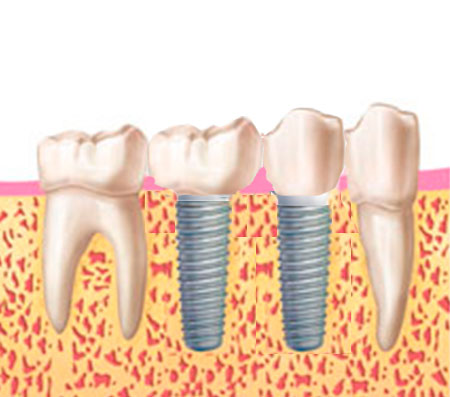 dientes sobre implantes muelas sobre implantes