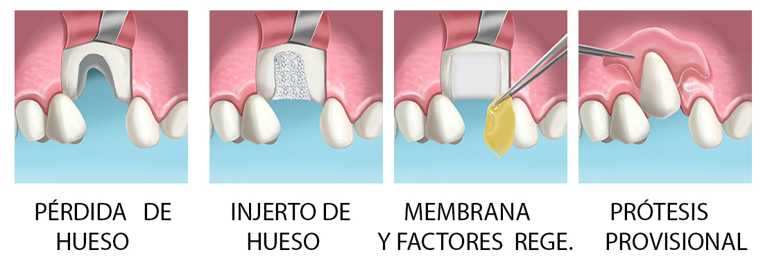 EXTRACCION DE DIENTES