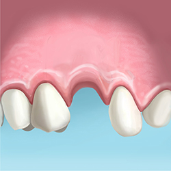 EXTRACCIÓN DE UN DIENTE Y COLOCACION DE UN IMPLANTE