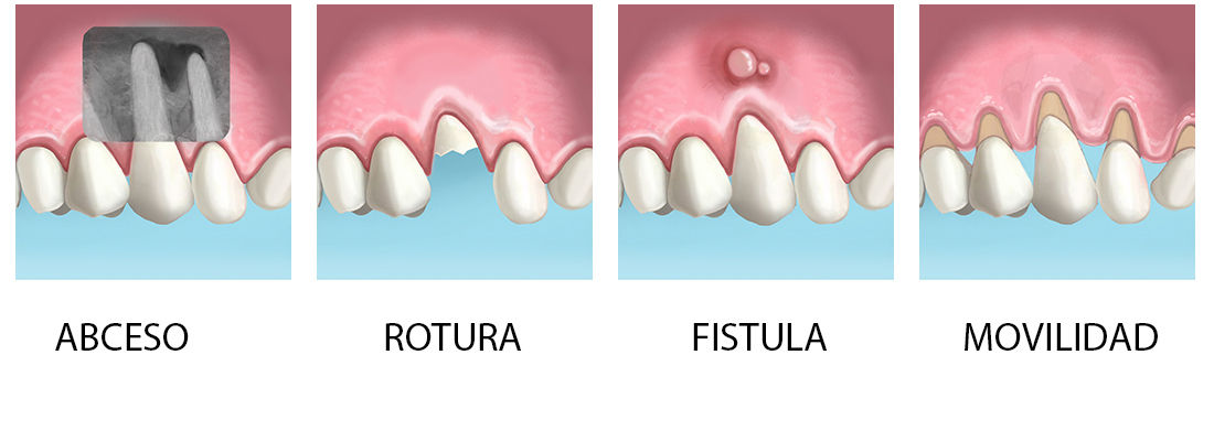 Extraccion de un diente y colocacion de un implante dental