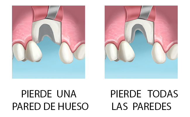 EXTRACCION DE UN DIENTE