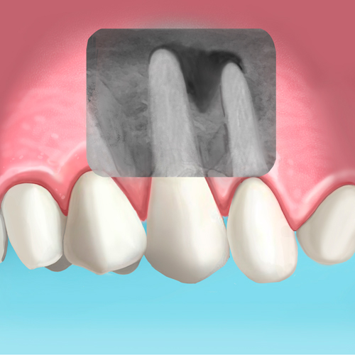 abceso dental extracción de diente
