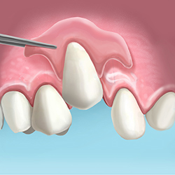 extraccion de diente