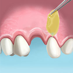 factores de regeneracion