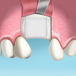 extraccion de diente