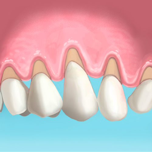 extracción de diente e implante dental