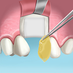 injerto de hueso extraccion de diente